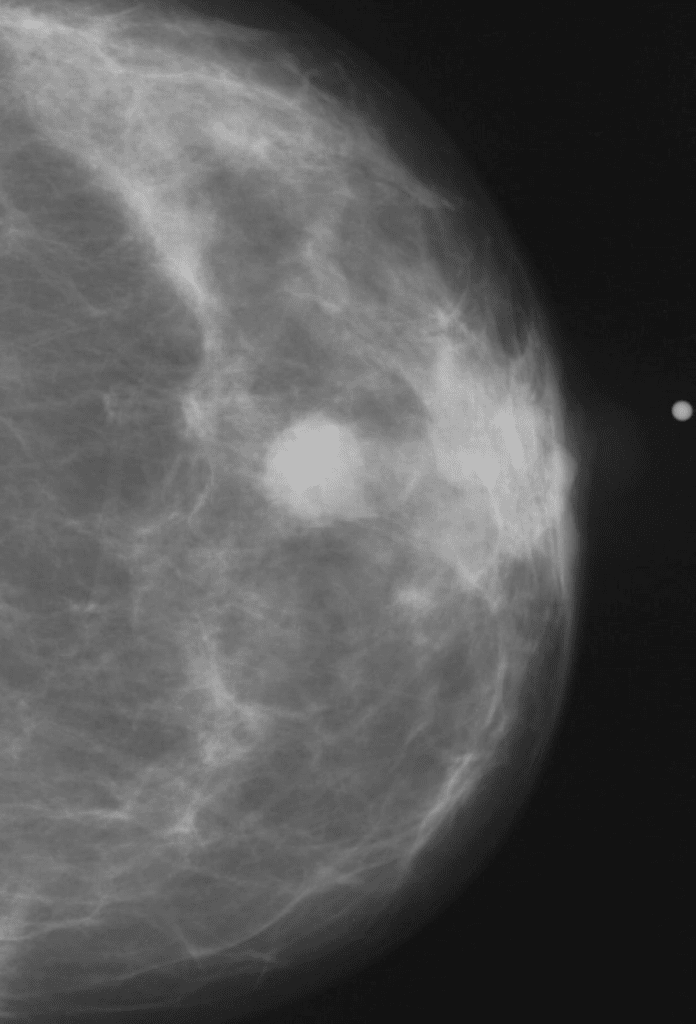 Regular Mammography Screenings Reduce Your Risk Of Dying From Breast